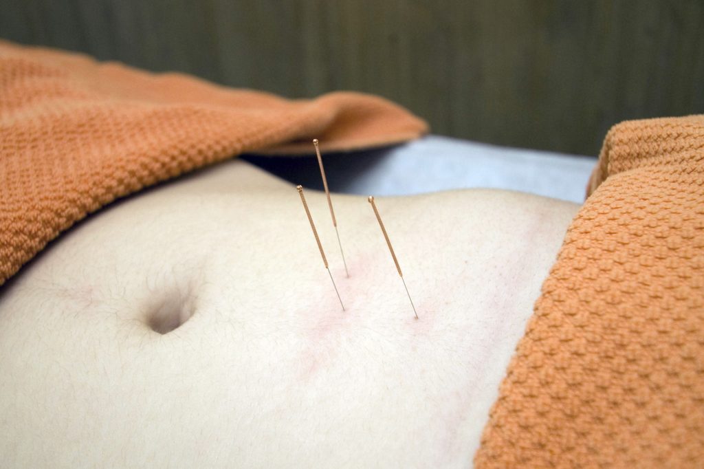 Akupunktura - opravdu je tak účinná? 4