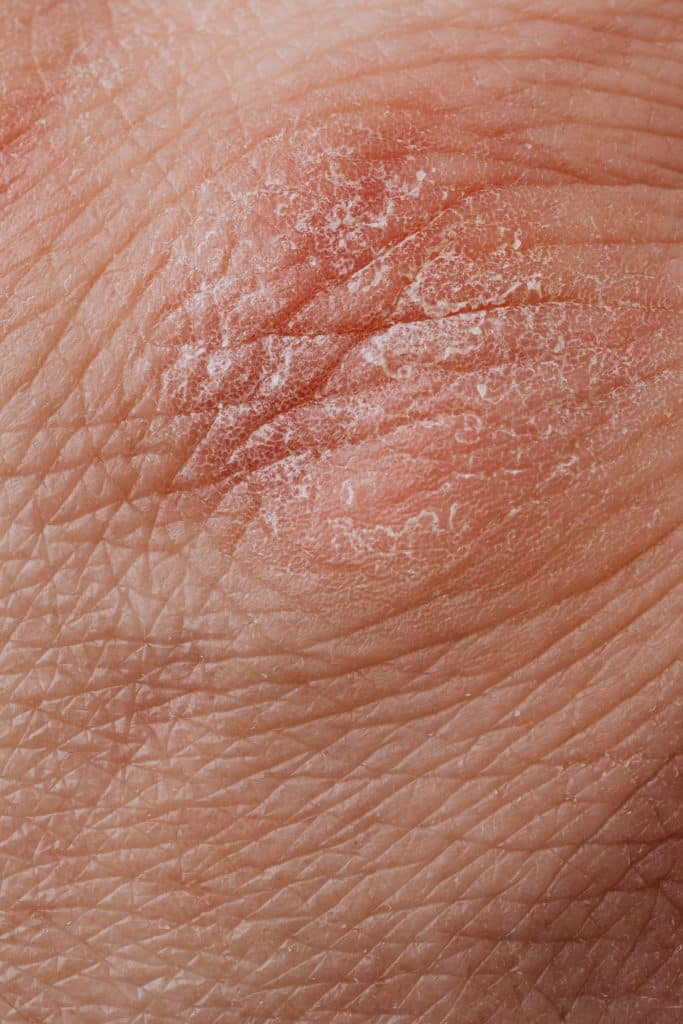 Přehled o typech dermatitidy: Znáte seboroickou, periorální nebo solární dermatitidu? 4